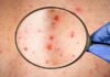 केरल में Monkeypox का तीसरा मामला आया सामने, स्वास्थ्य मंत्री ने की पुष्टि
